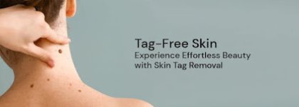 skin-tag-re.jpg